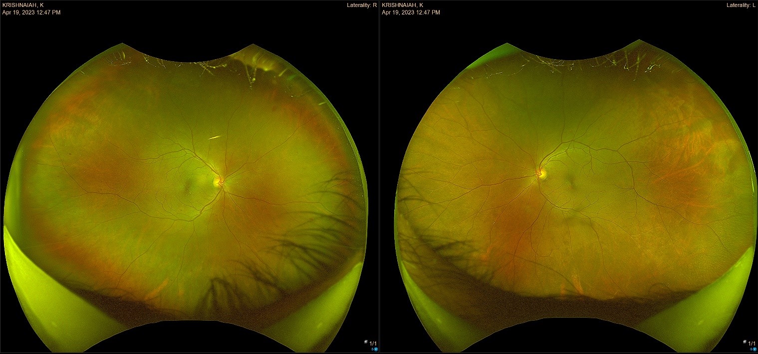 Blog Diabetic Retinopathy Prime Retina Eye Care Centre Best Eye Hospital in Hyderabad Best