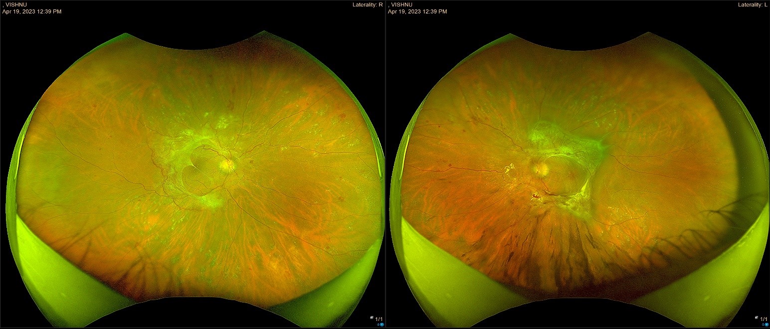 Blog Diabetic Retinopathy Prime Retina Eye Care Centre Best Eye Hospital in Hyderabad Best
