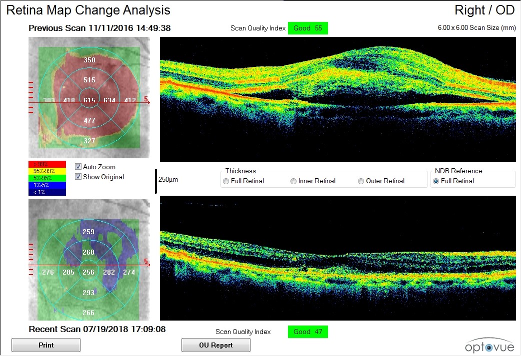 Blog Macular Degeneration Prime Retina Eye Care Centre Best Eye