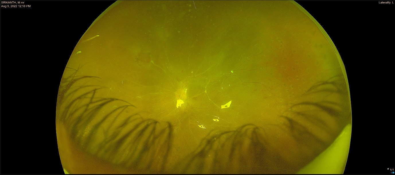 Blog Advanced Proliferative Diabetic Retinopathy Prime Retina Eye Care Centre Best Eye