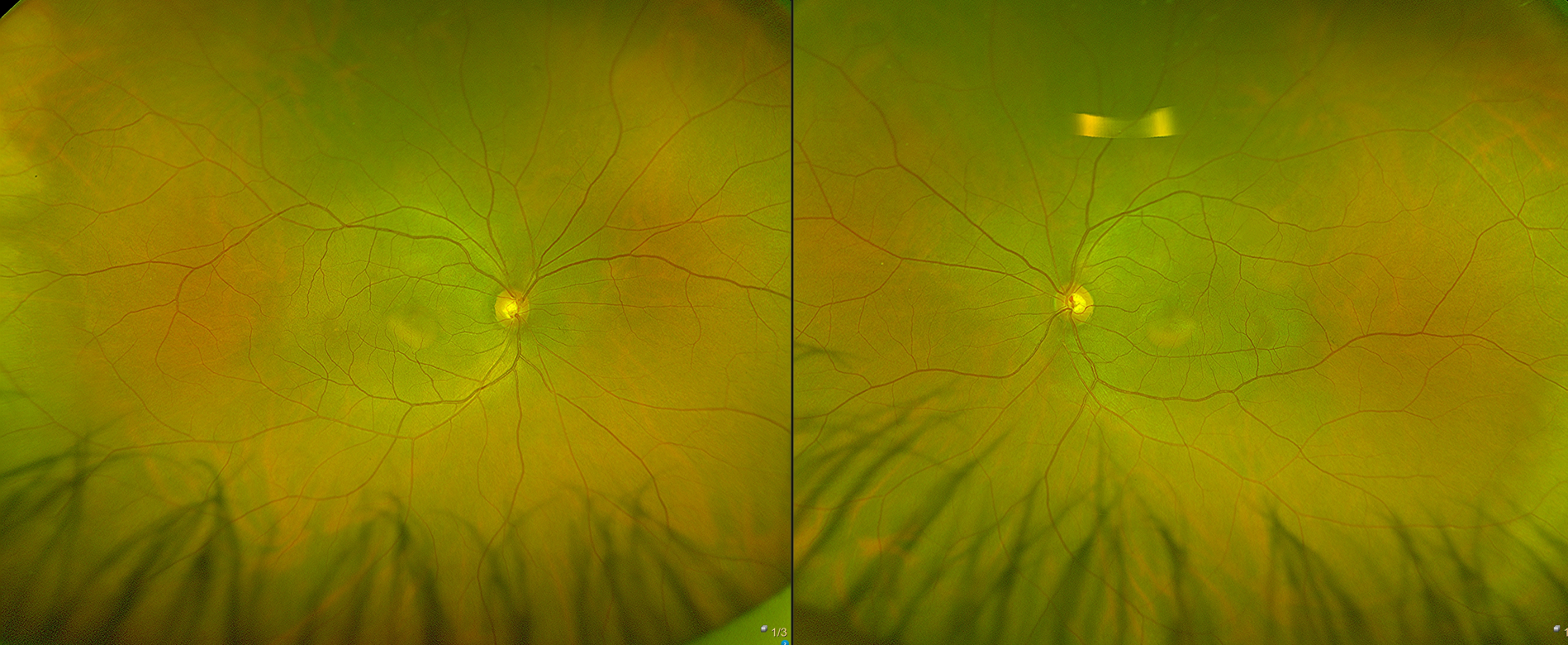 Pattern Dystrophy Optomap Blog Adult Onset Vitelliform Dystrophy - Prime Retina Eye Care Centre ...