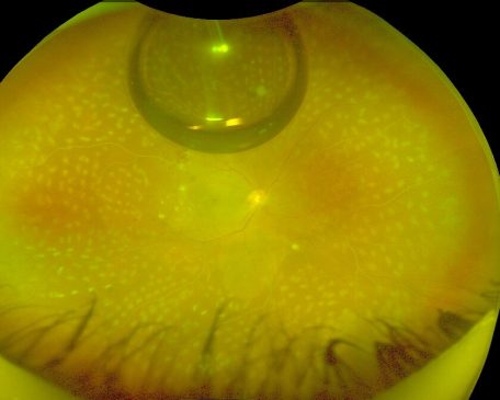 Blog-Prime Retina Best Retina Hospital